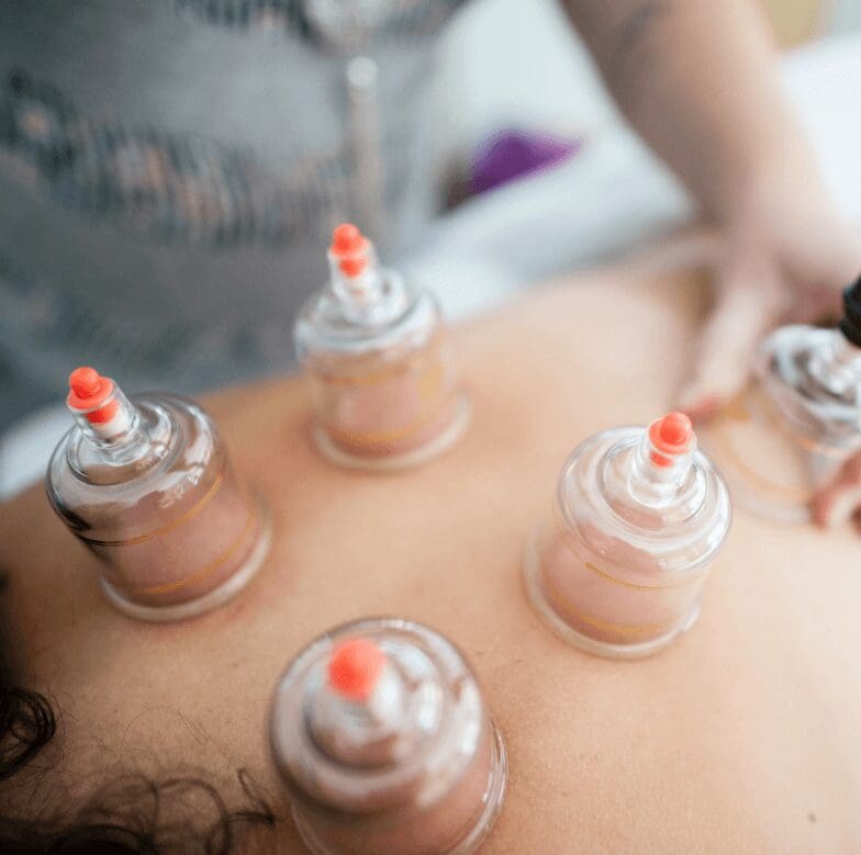 Acupuncture woman therapist placing the cup on the back of a female patient.